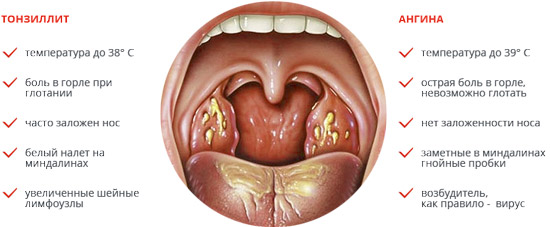 simptomy-xronicheskogo-tonzillita